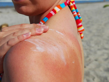 sunburn natural treatment